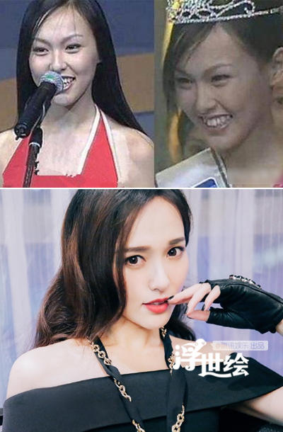 杨幂杨洋唐嫣郑爽都整过 矫正牙齿堪比整容